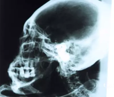 Il cranio di una mummia aliena