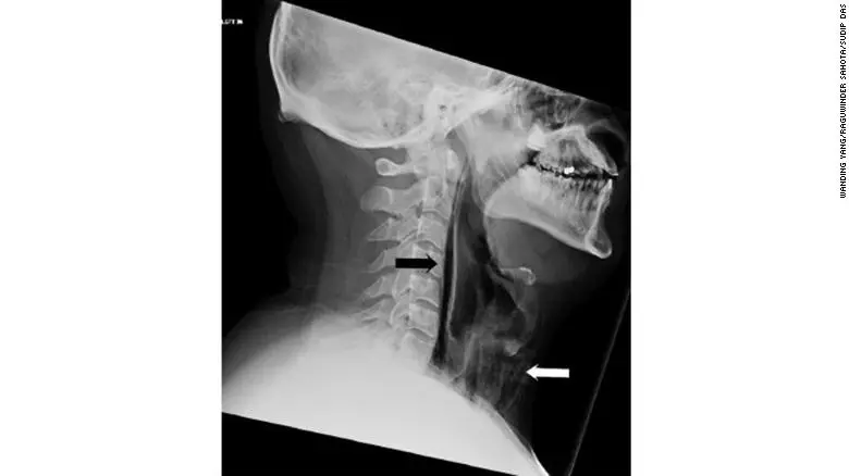 La gola perforata dell'uomo di cui si parla nell'articolo