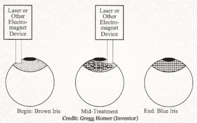 La procedura al laser