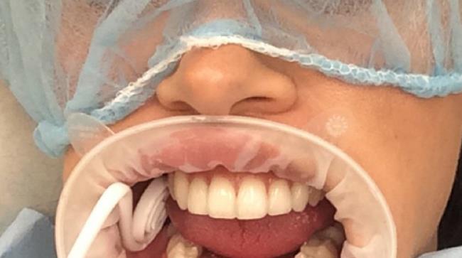 Belen Rodriguez dal dentista mostra il divaricatore fra i denti Belen Rodriguez si spara un selfie dal dentista