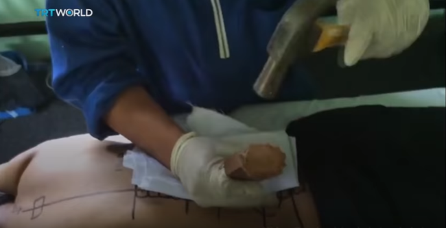 Il chiropratico malese che cura le ernie a martellate Il chiropratico si appresta a martellare il paziente