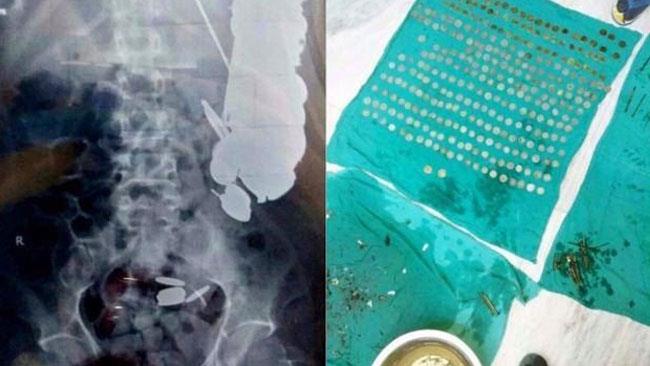 L'uomo salvadanaio operato d'urgenza: 263 monete nella sua pancia Tutte le monete e gli oggetti raccolti dall'uomo