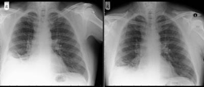 La radiografia dove si evidenzia la massa sospetta