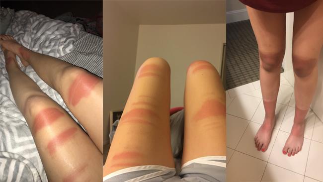 Nei mesi caldi, i jeans strappati hanno un difetto enorme I jeans strappati d'estate donano un'abbronzatura zebrata