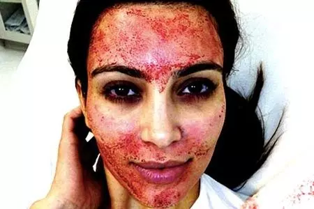 Il Vampire Breast lift ti regala tette più sode grazie al tuo sangue