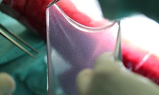 Pelle geneticamente modificata cura un ragazzino dato per spacciato Il lembo di epidermide geneticamente modificato