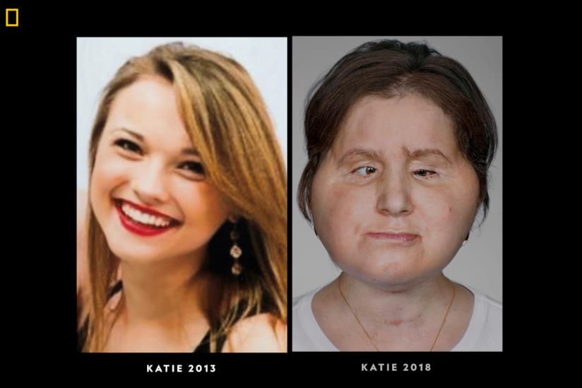 Katie Stubblefield Katie Stubblefield prima e dopo il trapianto di volto