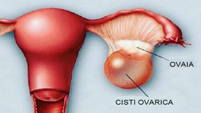 Ovaio policistico Ovaio policistico (foto Instagram)