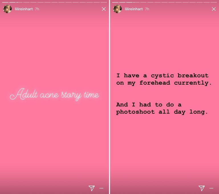 Lili Reinhart su Instagram parla dell'acne cistica Un'immagine dell'Instagram story di Lili Reinhart sui problemi di acne