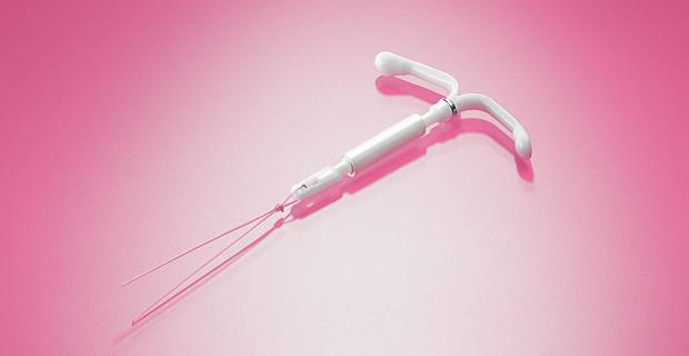 Metodi contraccettivi femminili impiantabili Metodi contraccettivi femminili impiantabili