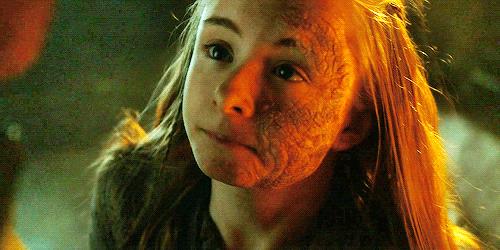 Shireen Baratheon Shireen Baratheon in primo piano con il morbo grigio in faccia