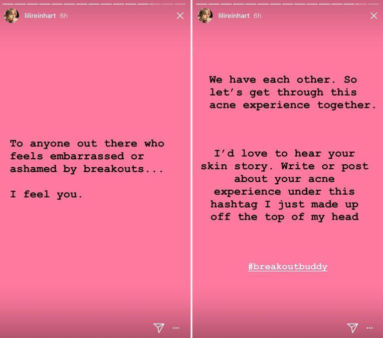 Lily Reinhart usa una Instagram Story per parlare dei suoi problemi di acne Lily Reinhart su Instagram
