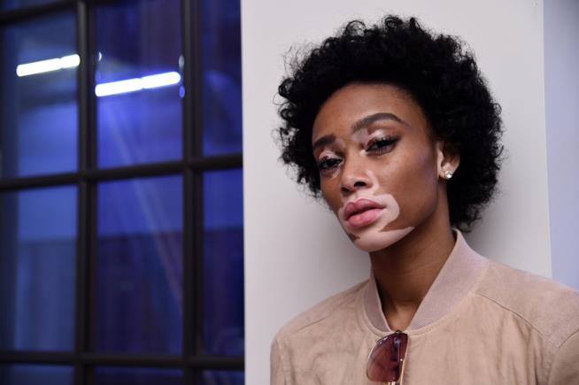 Sindromi e difetti: le modelle mettono in mostra la loro unicità Winnie Harlow, modella affetta da vitiligine