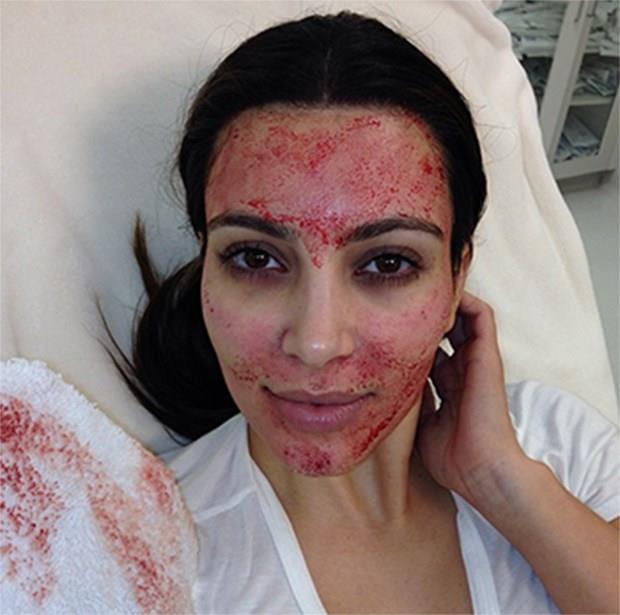 I trattamenti di bellezza più strani delle celebrities La maschera di bellezza con sangue di Kim Kardashian