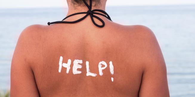 Ustioni e giornate di mare: un binomio forse scindibile La foto di una ragazza con la schiena scottata dal sole