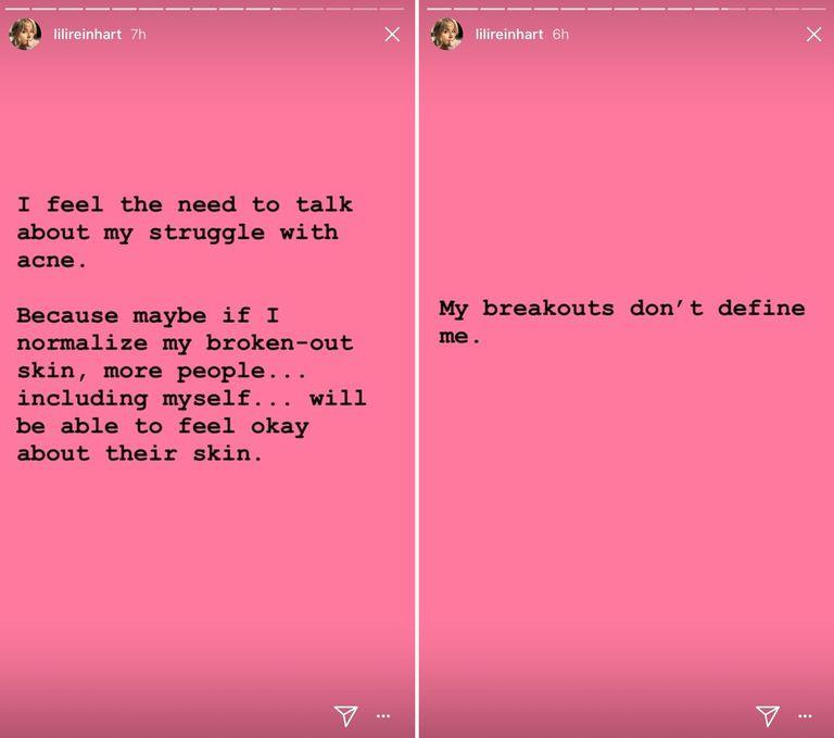 Lili Reinhart parla dell'acne su Instagram L'attrice Lili Reinhart scrive su Instagram