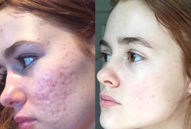 Kali Kushner e le altre influencer che hanno combattuto il cyberbullismo e l'acne La instagrammer Kali Kushner