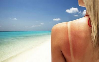 Scottatura solare Spalla arrossita dal sole