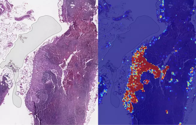 L'IA di Google per rilevare il cancro al seno è stata sottoposta a due test Si chiama LYNA lo strumento di Google contro il cancro