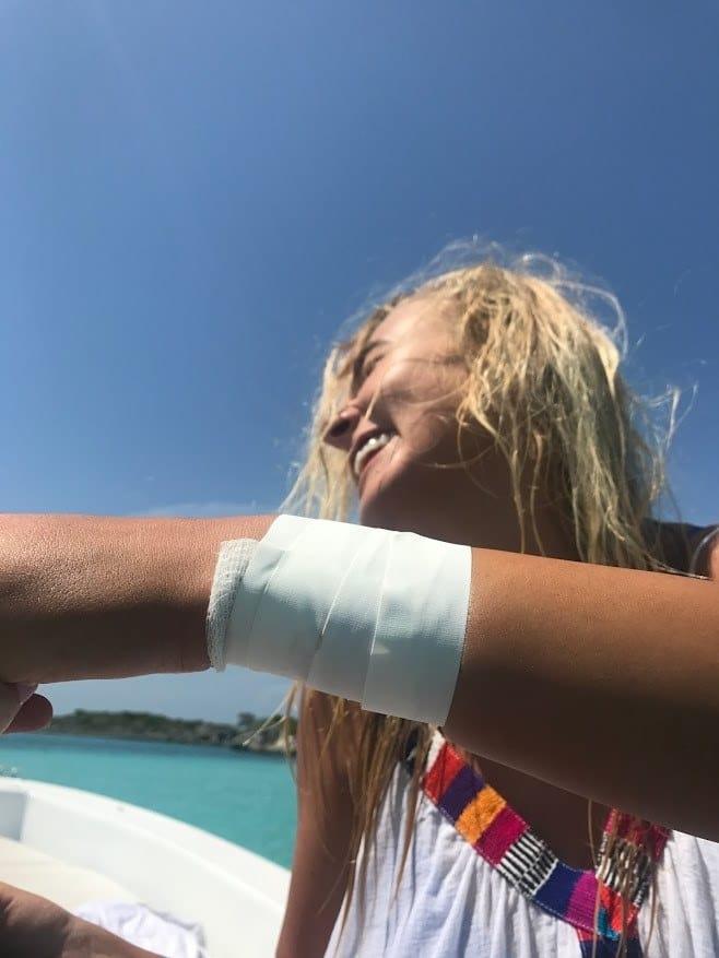 Una modella è stata morsa da uno squalo mentre faceva una foto Il braccio fasciato della modella dopo il morso dello squalo